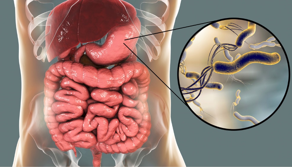 Helicobacter pylori
